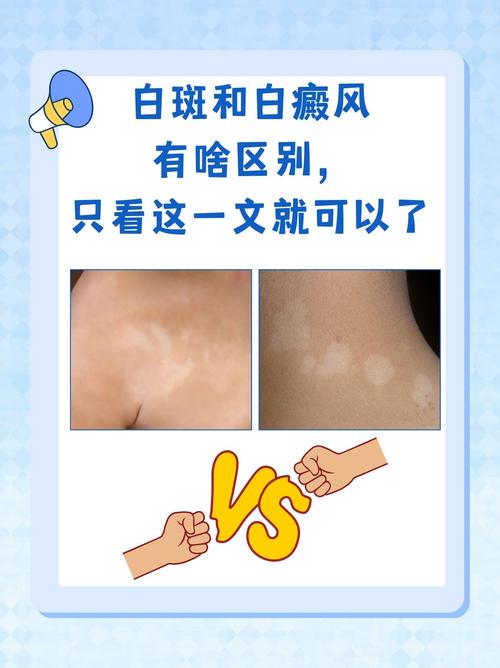 中山有哪些专治白癜风的医院 白癜风怎么治疗有效 中山有哪些专治白癜风的医院 白癜风怎么治疗有效