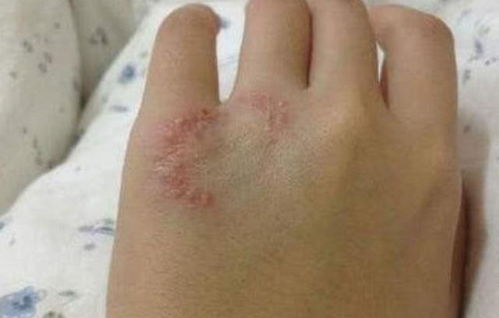 石家庄哪家医院治疗白癜风出名 白癜风在发展中的具体表现是什么呢 石家庄哪家医院治疗白癜风出名 白癜风在发展中的具体表现是什么呢