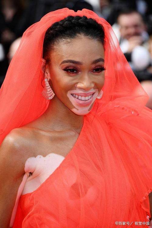 成都哪里治疗白癜风好白癜风怎么治疗是会好呢 成都哪里治疗白癜风好白癜风怎么治疗是会好呢