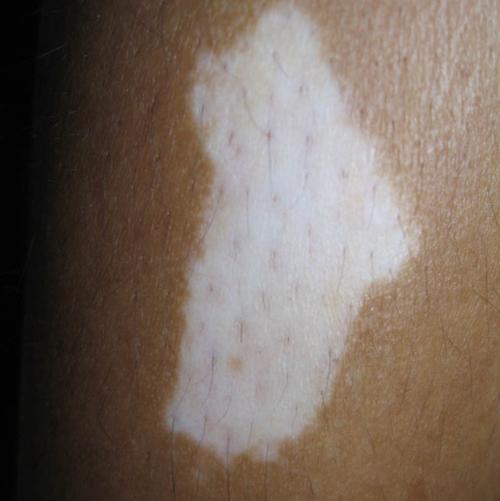 ��ͷ�ΰ����ר��ҽԺ ���粻�ܳ�ʲô