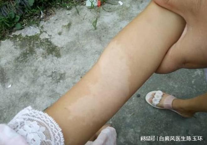 白癜风早期症状和危害 白癜风早期症状和危害