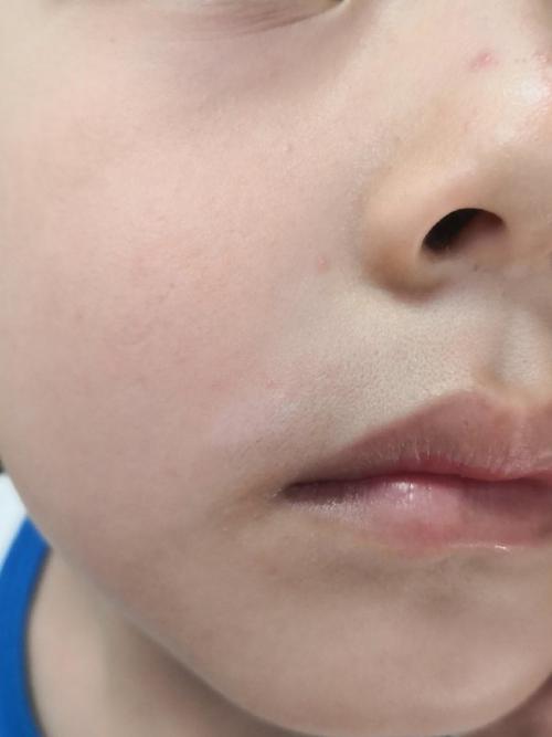 白癜风医疗的饮食禁忌 白癜风医疗的饮食禁忌