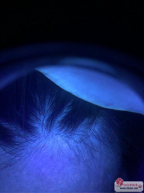 白癜风诊断做什么检查 白癜风诊断做什么检查