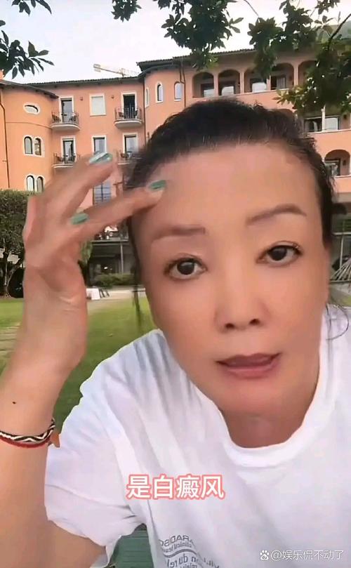 医院怎么检查白癜风的 医院怎么检查白癜风的