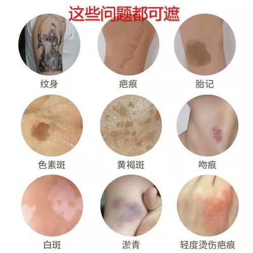 朝阳白癜风治疗最好医院 朝阳白癜风治疗最好医院