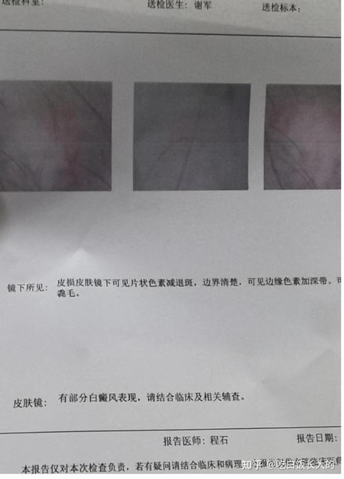 任家萱的疤痕恢复了吗 任家萱的疤痕恢复了吗