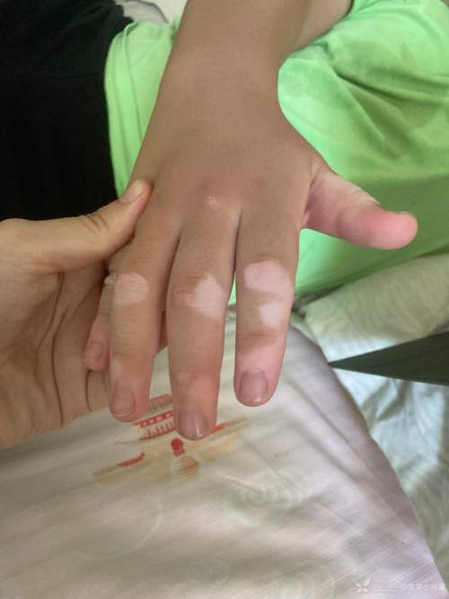 成都哪家医院治疗白癜风好 青少年治疗白癜风 成都哪家医院治疗白癜风好 青少年治疗白癜风