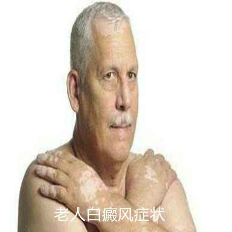 白癜风早期如何控制用药 白癜风早期如何控制用药