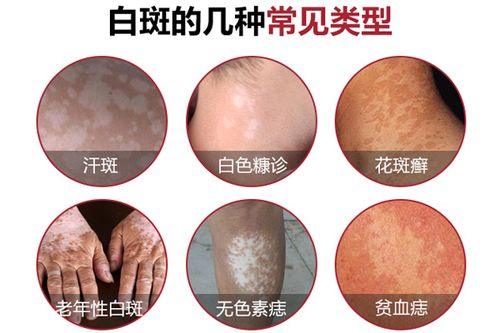 哪些白癜风可以做全身光疗 广州哪家医院能治疗白癜风 哪些白癜风可以做全身光疗 广州哪家医院能治疗白癜风
