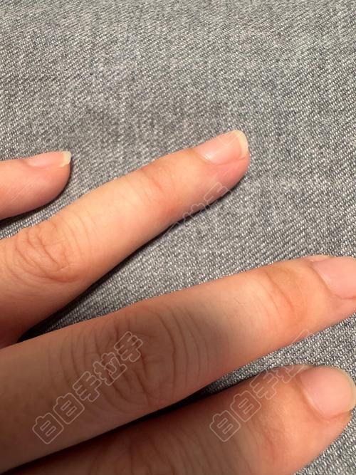 湘潭专业治疗白癜风 湘潭治风湿最好的医院 湘潭专业治疗白癜风 湘潭治风湿最好的医院