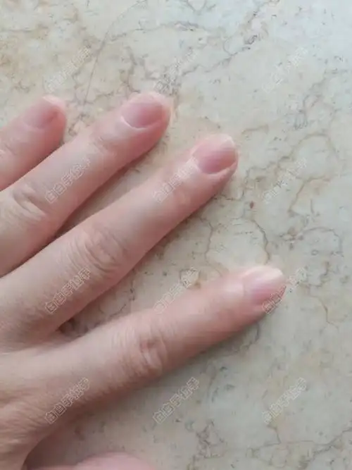 医院治疗儿童白癜风好吗 医院治疗儿童白癜风好吗