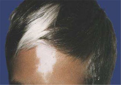 18岁白癜风 18岁白癜风初期治疗 18岁白癜风 18岁白癜风初期治疗