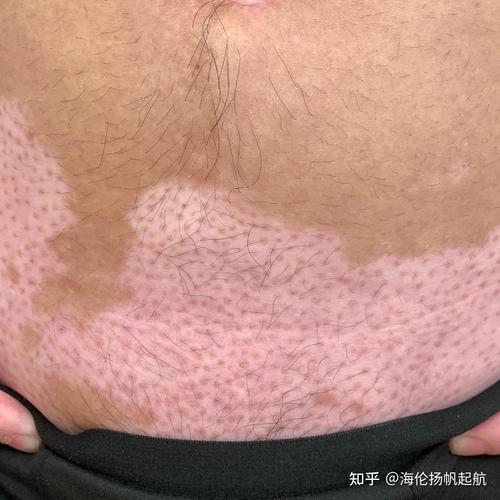 抚州治疗白癜风哪里好 儿童白癜风怎么治疗