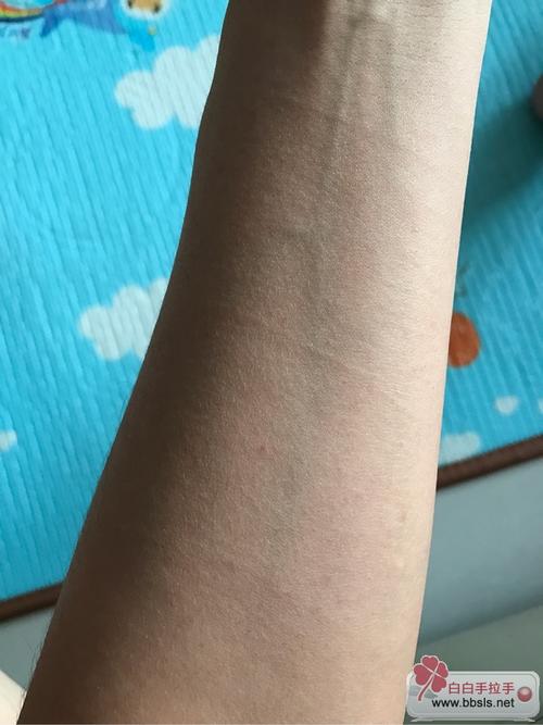 单纯糠疹与白癜风如何区别 伊春治白癜风哪家医院知名 单纯糠疹与白癜风如何区别 伊春治白癜风哪家医院知名