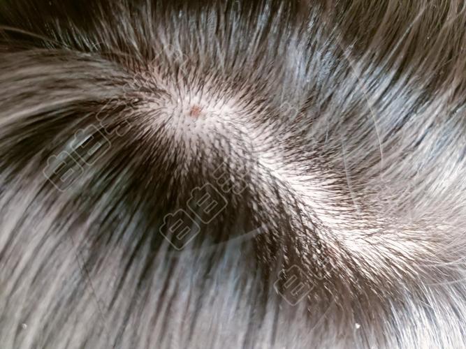 白癜风的预防方法有哪些呢 白癜风的预防方法有哪些呢