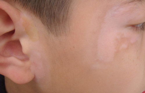 С������ĳ���֢״ տ���ļ�ҽԺ�����εú�