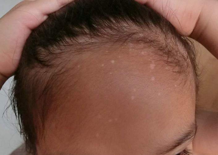 白癜风吃什么食物好 唐山治白癜风的医院哪家好