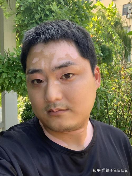 为什么会得白癜风这个病 为什么会得白癜风这个病