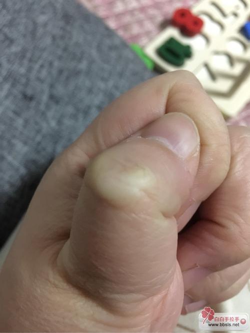 白癜风的发生因素 白癜风的发生因素有哪些 白癜风的发生因素 白癜风的发生因素有哪些