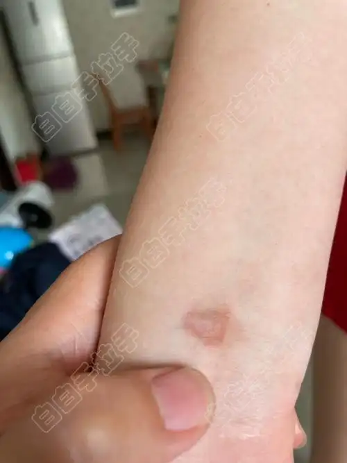 哪些工作容易患上白癜风 哪些工作容易患上白癜风