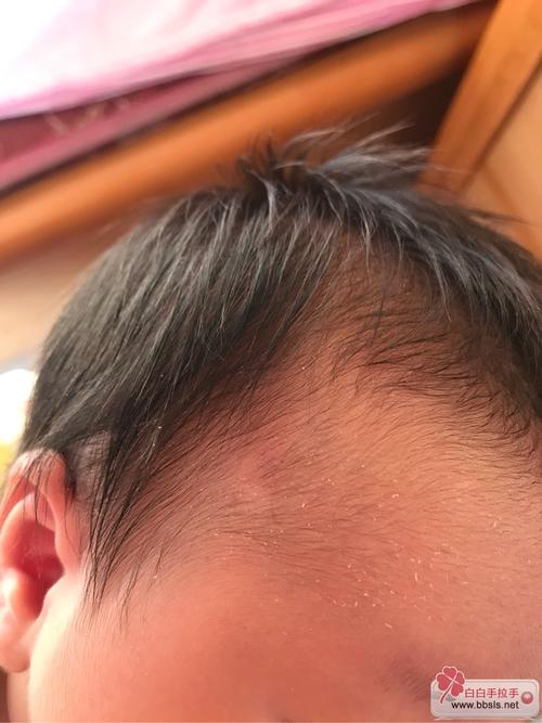 白癜风食疗可以治好吗 白癜风食疗可以治好吗