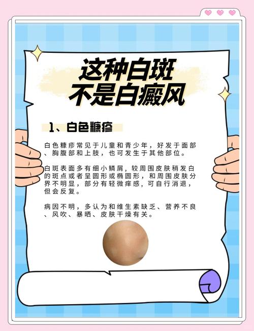 白癜风吃药可以控制么 白癜风吃药可以控制么