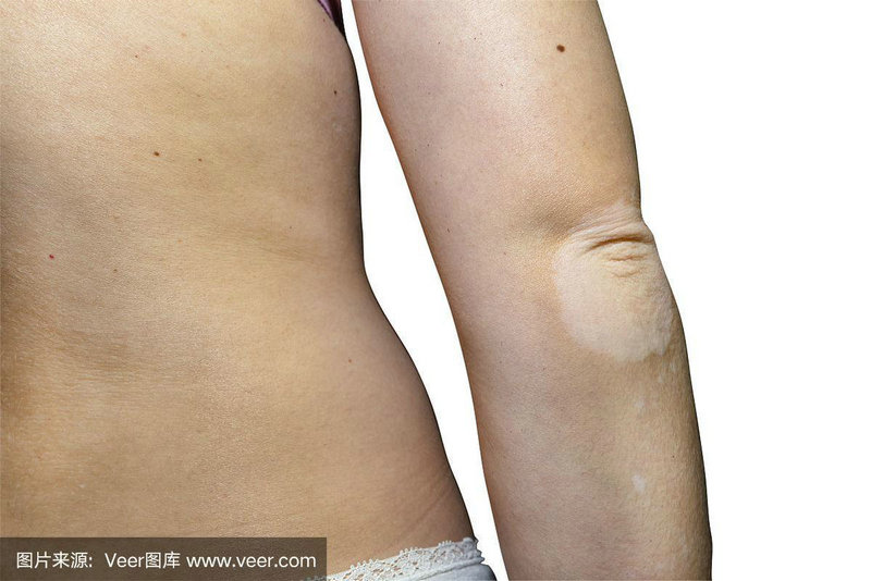 白癜风在哪里可治好 白癜风哪里可以治愈 白癜风在哪里可治好 白癜风哪里可以治愈