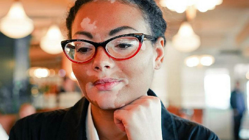 得了白癜风怎么护理 郑州白癜风治疗医院哪家专业 得了白癜风怎么护理 郑州白癜风治疗医院哪家专业