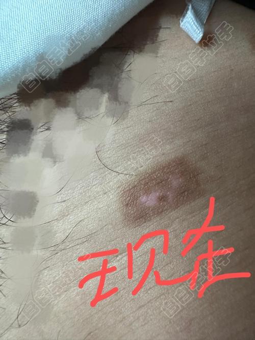 治白癜风的医院 治疗白癜风专业的医院 治白癜风的医院 治疗白癜风专业的医院