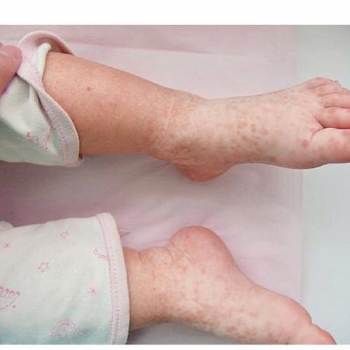 自制白癜风光疗仪 家用白癜风光疗机 自制白癜风光疗仪 家用白癜风光疗机