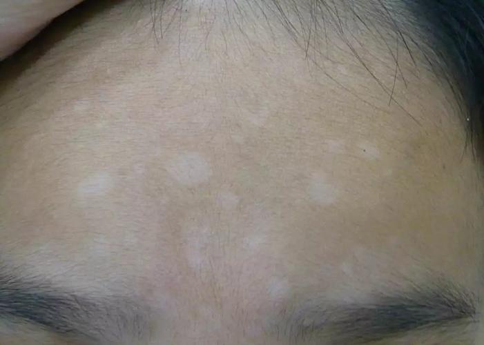 白癜风恢复最快的偏方 白癜风恢复最快的偏方