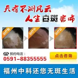 白癜风是不是会传染 石嘴山治白癜风到哪里 白癜风是不是会传染 石嘴山治白癜风到哪里