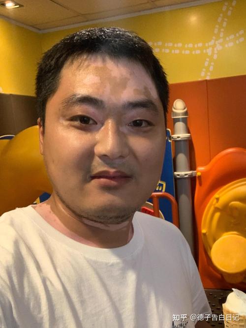 鞍山白癜风专科医院(鞍山治白癜风最权威的医院是哪个) 鞍山白癜风专科医院(鞍山治白癜风最权威的医院是哪个)