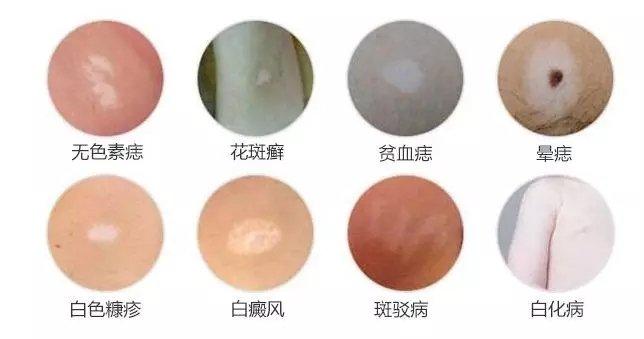 白癜风恢复是什么过程 白癜风恢复是什么过程