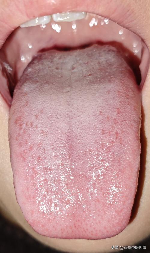 ��ǰ���֢״ ��ǰ�������