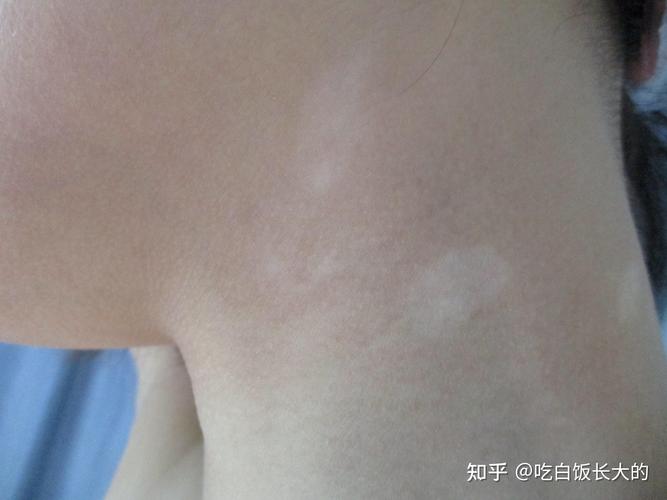 生白癜风的原因 白癜风生长 生白癜风的原因 白癜风生长