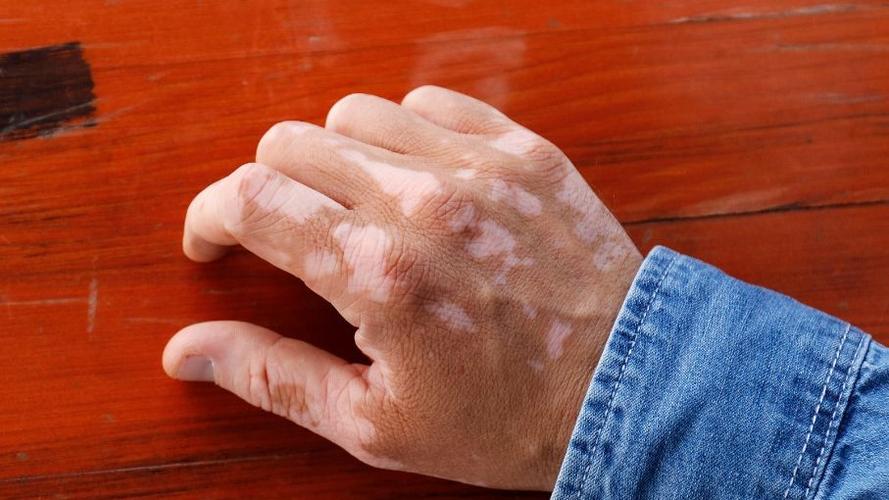 太原治疗白癜风的过程 太原治疗白癜风的过程