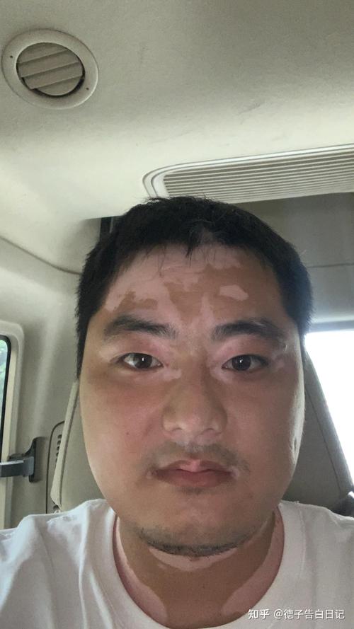 东莞白癜风治疗费用 东莞白癜风诊疗 东莞白癜风治疗费用 东莞白癜风诊疗