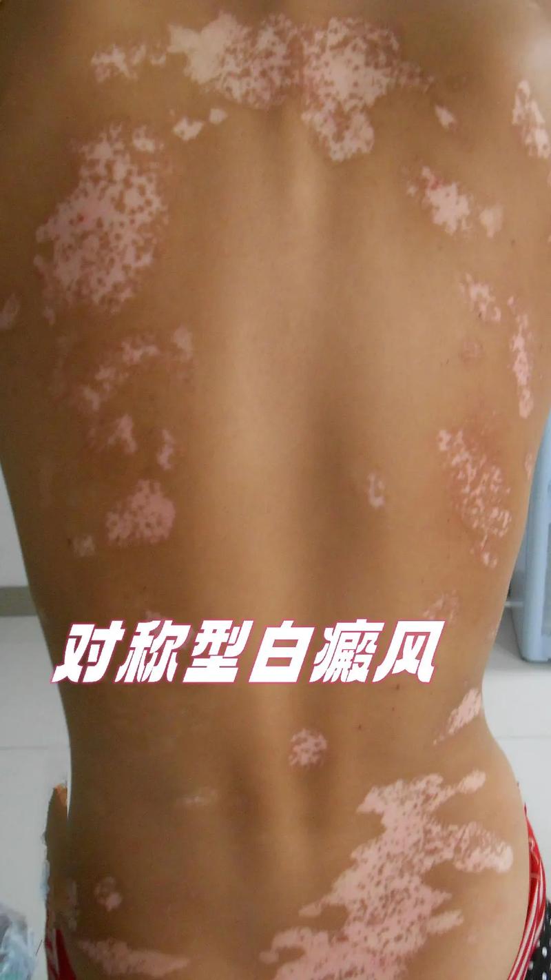 西安治疗儿童白癜风医院口碑前五用药物治白癜风的缺点有什么 西安治疗儿童白癜风医院口碑前五用药物治白癜风的缺点有什么