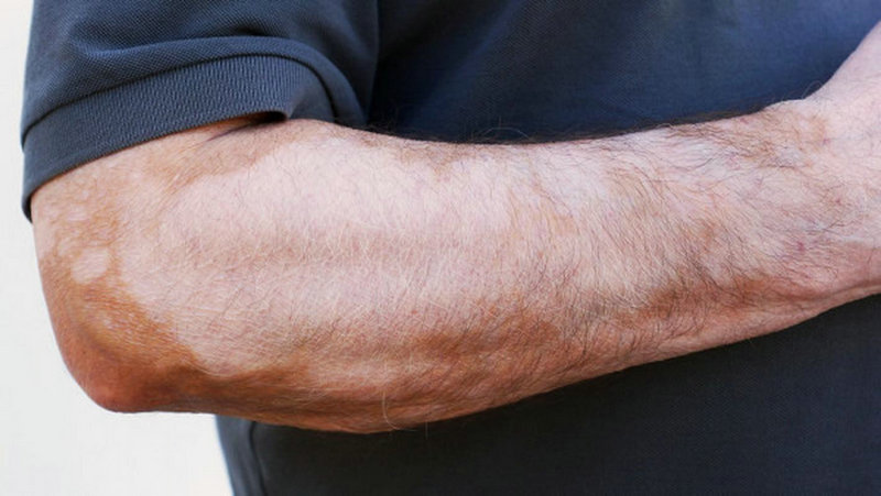 铜离子缺乏为什么会引发白癜风 长沙治疗白癜风好的专科医院 铜离子缺乏为什么会引发白癜风 长沙治疗白癜风好的专科医院