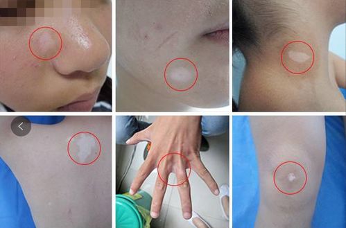 深圳医治白癜风医院 白癜风药物治疗 深圳医治白癜风医院 白癜风药物治疗