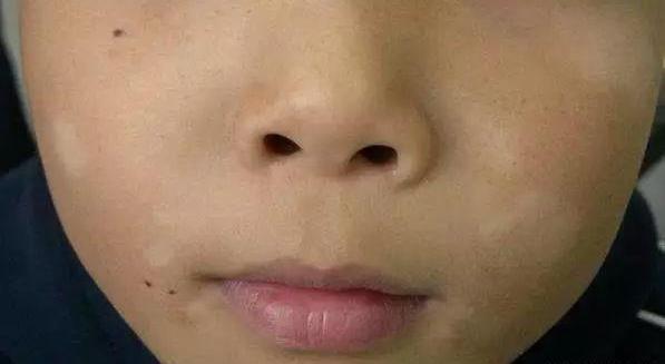 南宁白癜风看哪个科 白癜风在南宁哪里治疗最好 南宁白癜风看哪个科 白癜风在南宁哪里治疗最好