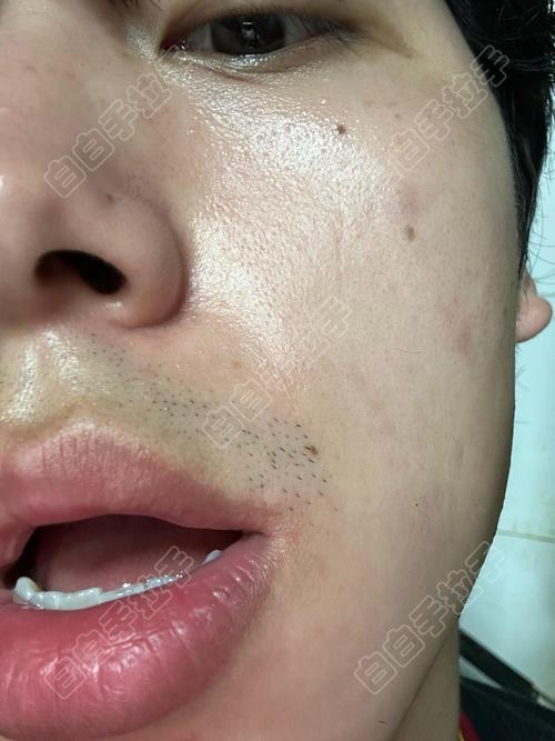 白癜风要用什么药涂的好 白癜风要用什么药涂的好