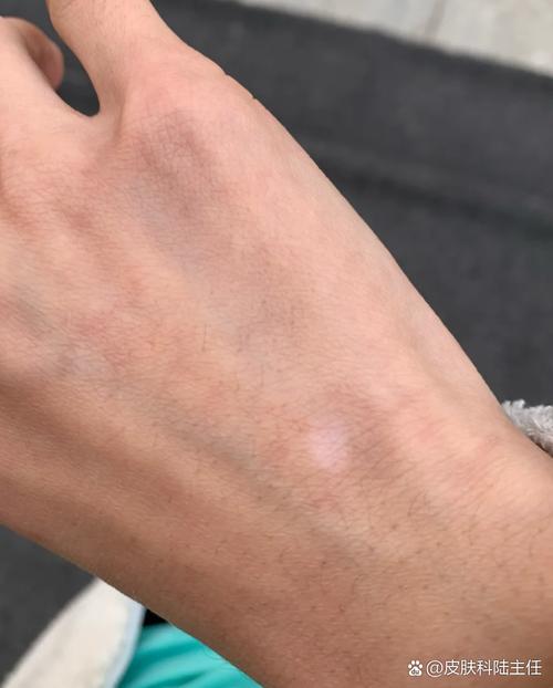 �����ΰ���ҽԺ�ļҺ� ����������Ƥ��ֲ������ô����