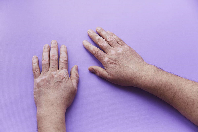 癌症会引起白癜风吗癌症会引起白血病吗 癌症会引起白癜风吗癌症会引起白血病吗