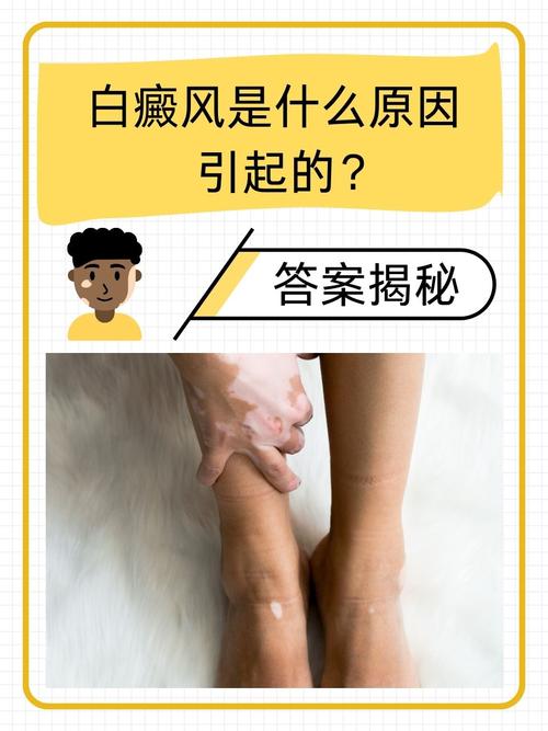 天水白癜风医院哪家正规 天水白癜风医院哪家正规