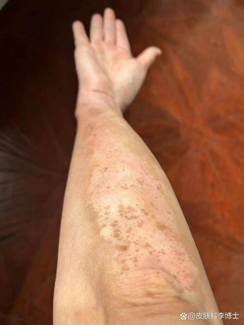 广州看白癜风比较好的医院 广州看白癜风比较好的医院