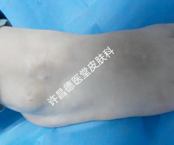 白癜风真面目 了解这些特征 早发现早治疗 白癜风真面目 了解这些特征 早发现早治疗