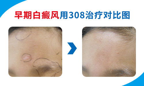 临沂哪家的医院治疗白癜风好 什么是局限型白癜风 临沂哪家的医院治疗白癜风好 什么是局限型白癜风