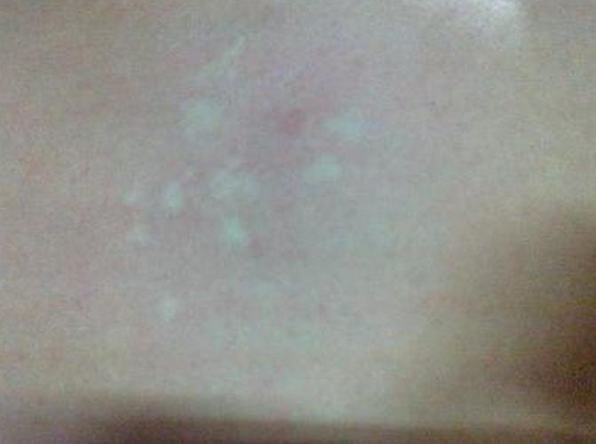 临沂哪里看白癜风好的医院 单纯糠疹与白癜风如何区别 临沂哪里看白癜风好的医院 单纯糠疹与白癜风如何区别